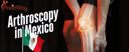 Arthroscopy in Mexico: A Minimally Invasive Option for Canadians